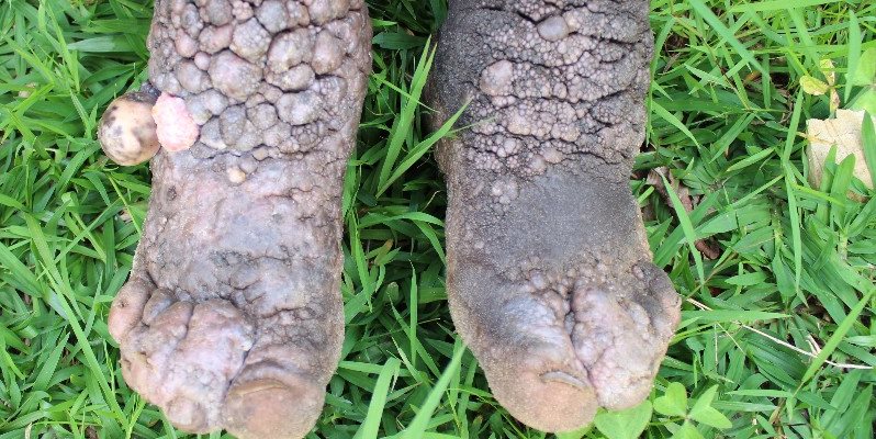 A close up of a podoconiosis patient's feet and legs
